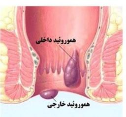 بواسیر و درمان آن