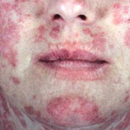 لوپوس چیست و چه علائمی دارد؟