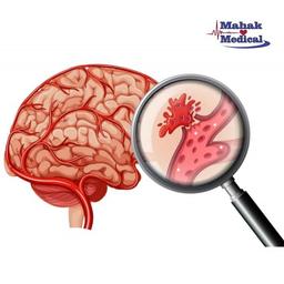 آیا میدانید بهترین راه درمان سکته مغزی چیست؟