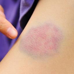 بیماران هموفیلی با چه مشکلاتی مواجهه هستند؟