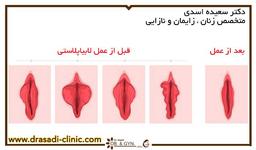 انواع روش های عمل لابیاپلاستی